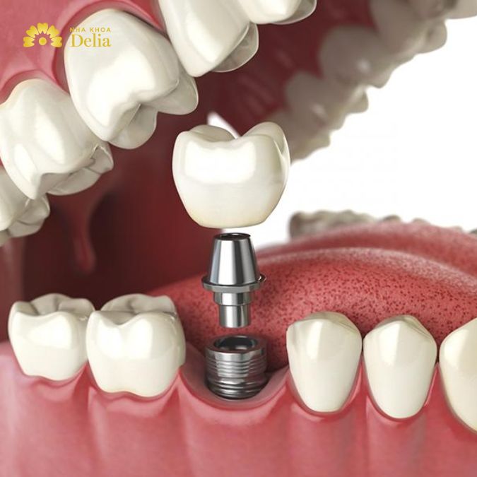 Quy trình trồng Implant phức tạp và thời gian hồi phục dài
