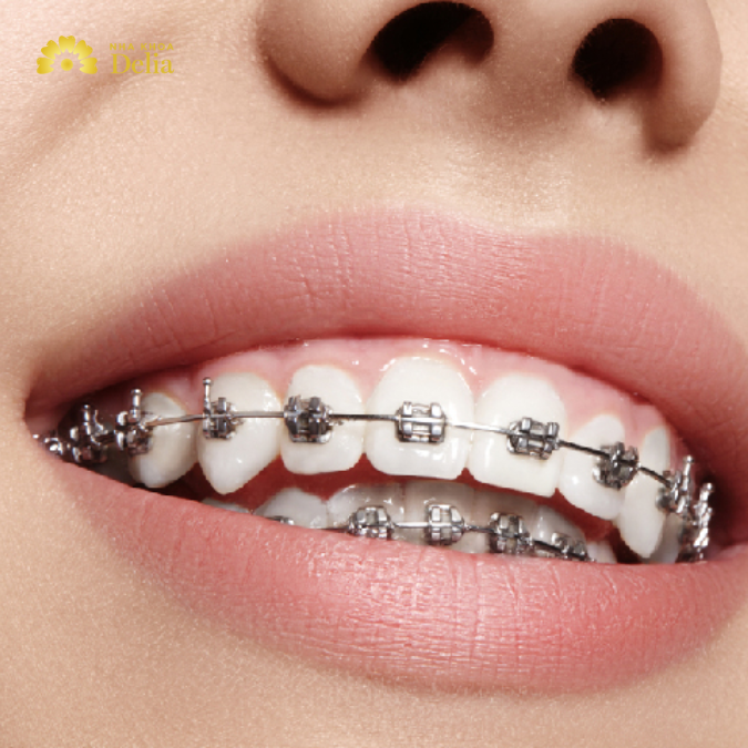 Chỉnh nha – niềng răng thực chất là một giải pháp an toàn, có thể đau nhưng chỉ là những cơn đau thoáng qua