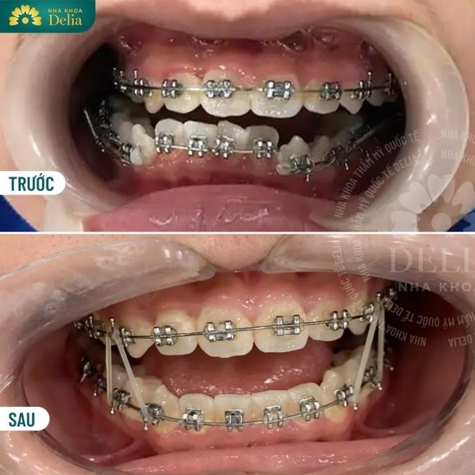 Quá trình niềng răng có giúp cải thiện các bệnh lý về răng miệng