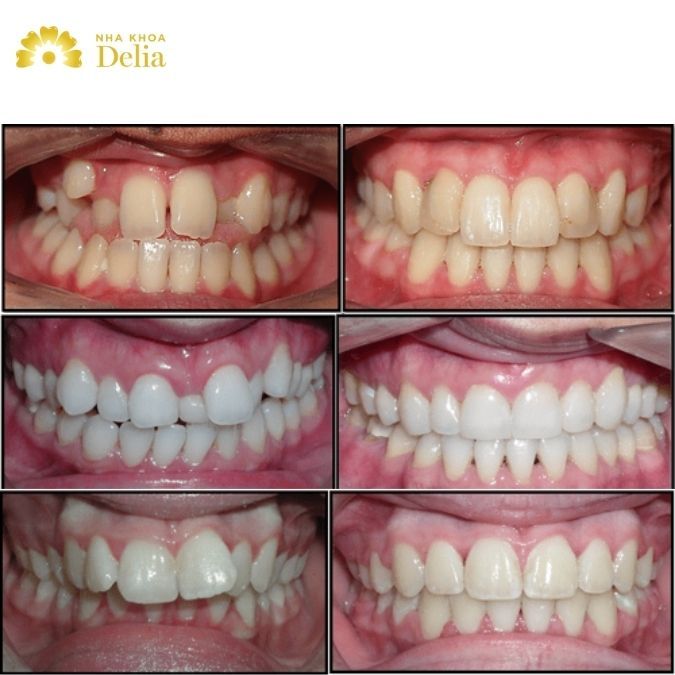 Rất nhiều khách hàng thực hiện niềng răng thẩm mỹ tại nha khoa Delia đều cho biết họ rất hài lòng với kết quả cuối cùng