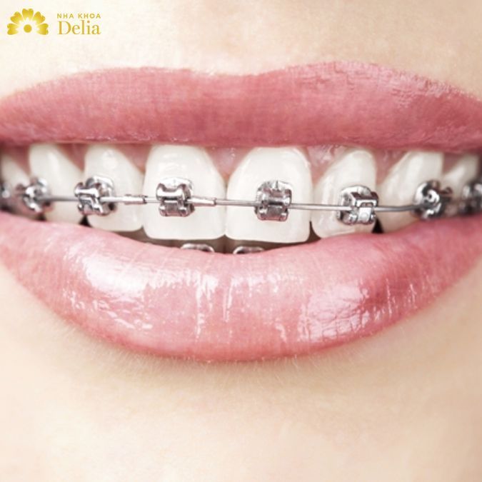 Tùy vào nhu cầu của mình, bạn có thể lựa chọn phương pháp niềng răng phù hợp