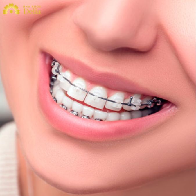 Niềng răng loại nào tốt nhất còn phải dựa vào tình trạng răng miệng cụ thể