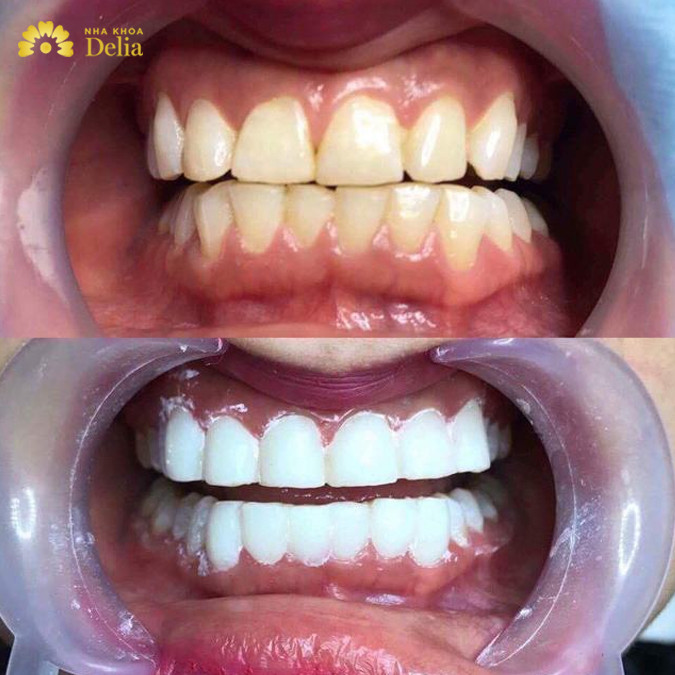 Trước và sau khi phủ sứ nano cho răng