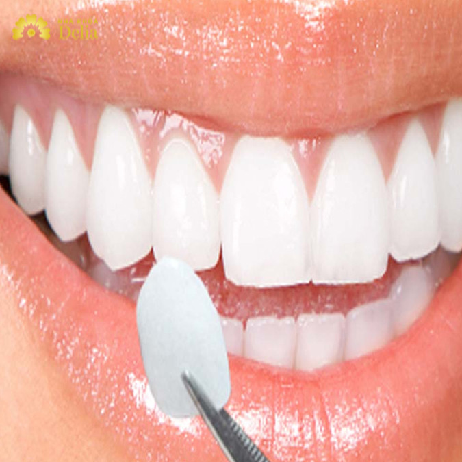 Điểm khác biệt là chất liệu phủ/ dán lên bề mặt răng thật dẫn đến độ bền khác nhau