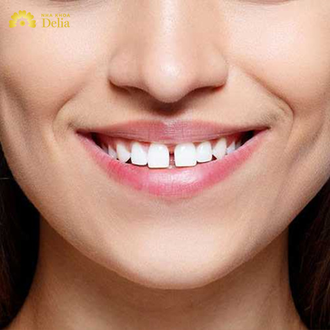 Răng cửa thưa do kích thước răng và xương hàm