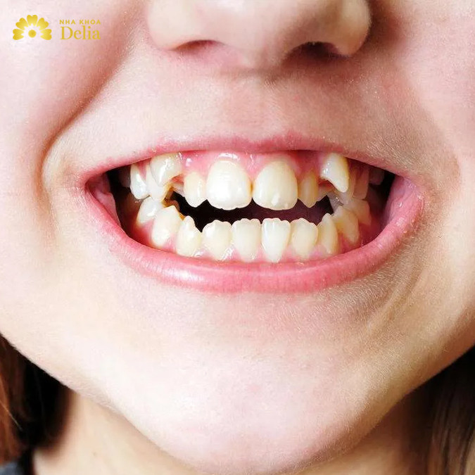 Răng khấp khểnh, không đều nên làm gì
