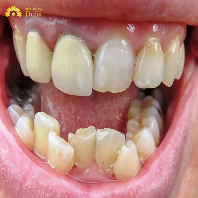 Răng khấp khểnh nặng