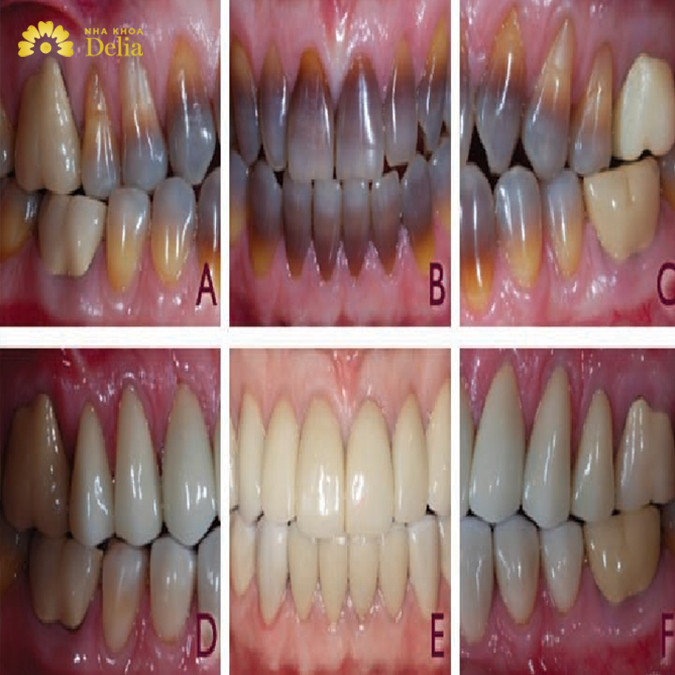 Tình trạng răng nhiễm Tetracycline