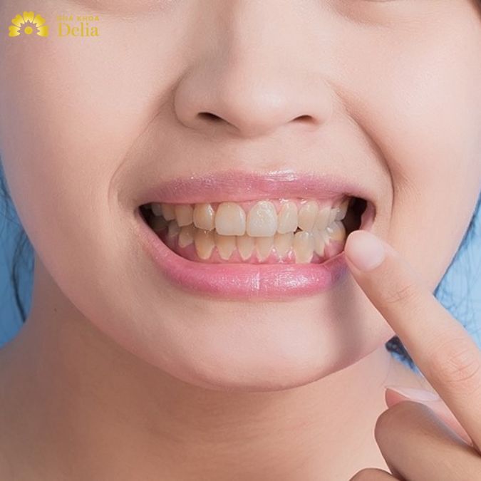 Răng ố vàng – Nguyên nhân, cách khắc phục màu răng tự nhiên nhanh nhất