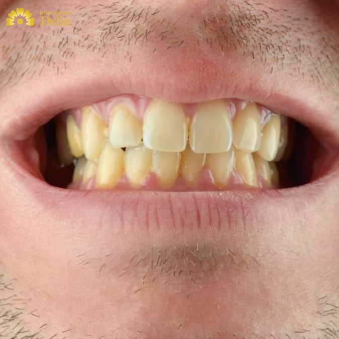 Răng trở nên ố vàng có thể là do hút thuốc lá quá nhiều