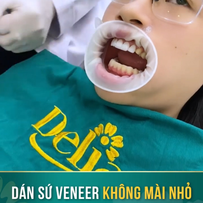 Dán sứ veneer khắc phục tình trạng răng sứ bị xỉn màu