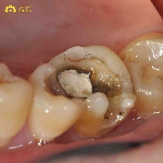 Sâu răng có mủ, viêm lợi