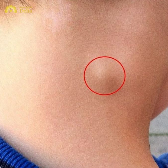 Sâu răng nổi hạch
