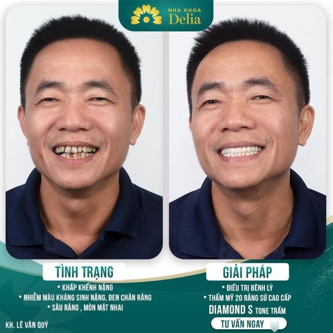 Giải pháp hiệu quả nhất khi bị sâu răng