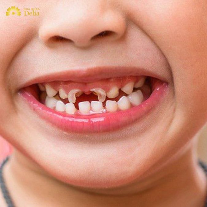 Trẻ em sâu răng sữa phải làm sao?