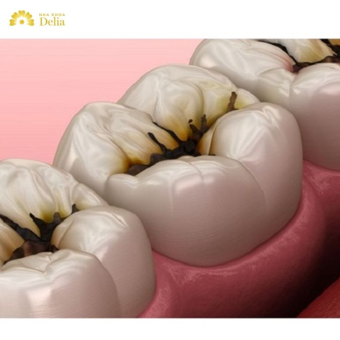 Thuốc chấm sâu răng có tác dụng trị sâu răng không?