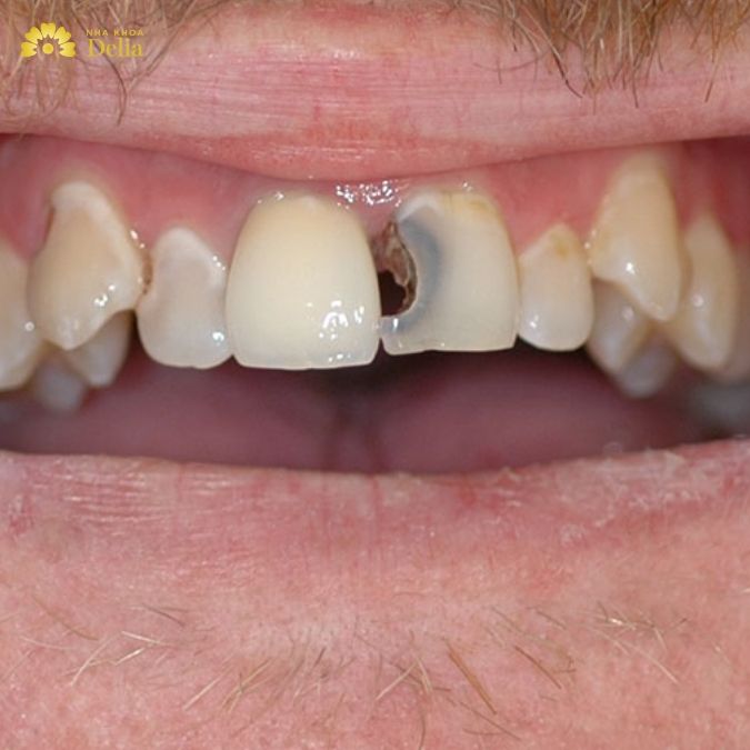 Sâu răng cửa có chữa được không?