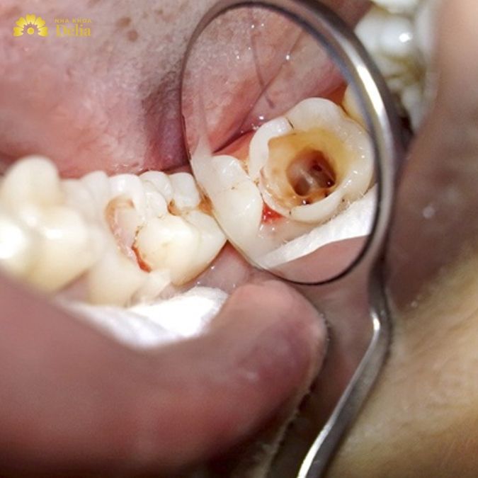 Sâu răng hàm số 7 phải làm sao?