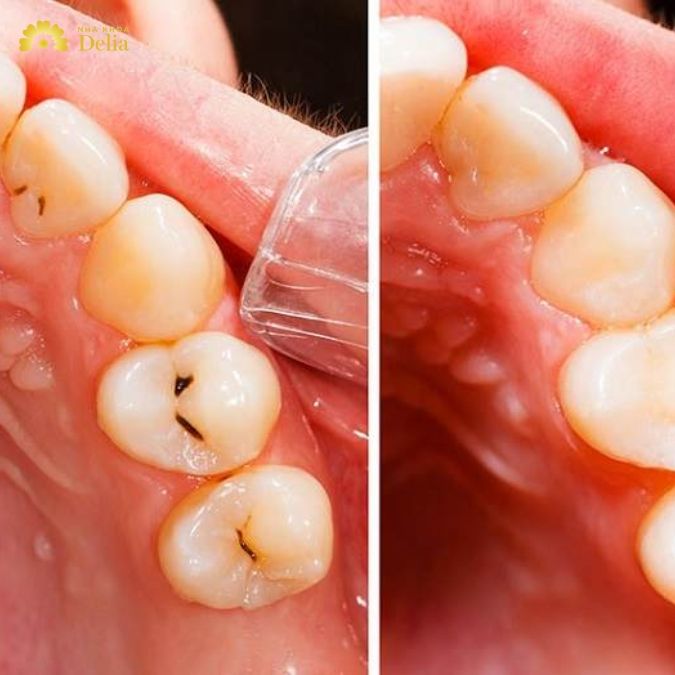 Dấu hiệu sâu răng giai đoạn đầu