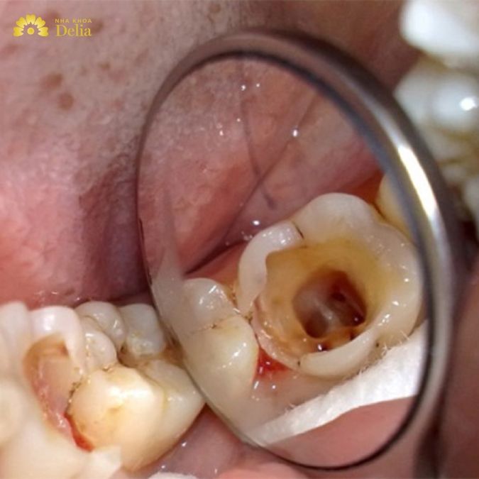 Dấu hiệu sâu răng lâu năm