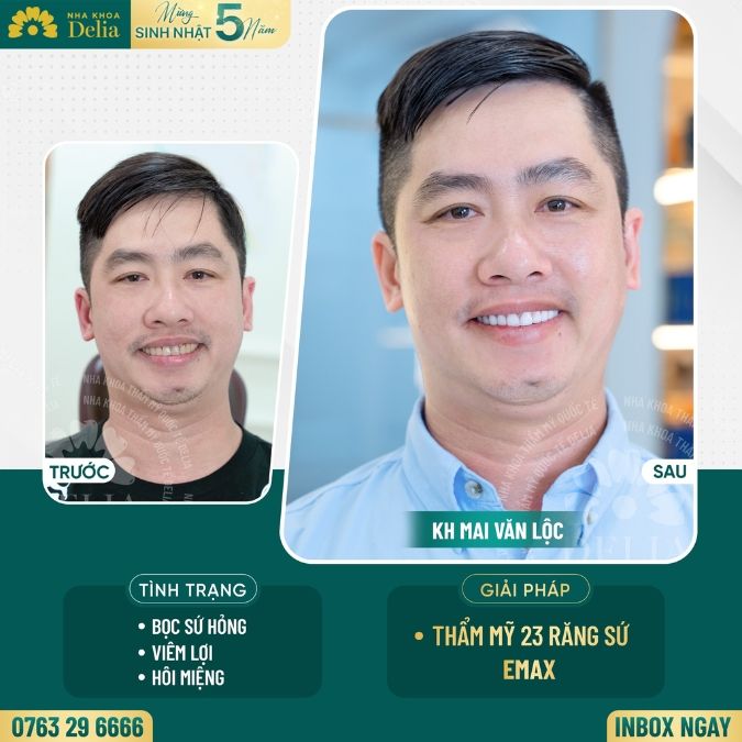 Các bước phục hình răng phủ sứ hỏng tại nha khoa Delia