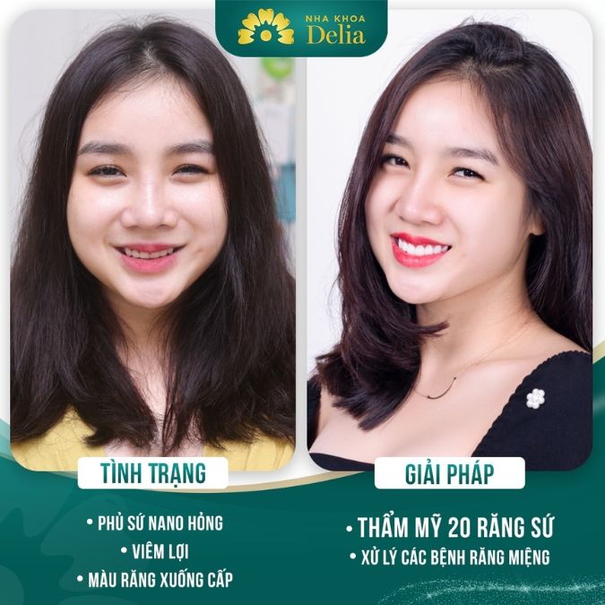 Thẩm mỹ răng sứ