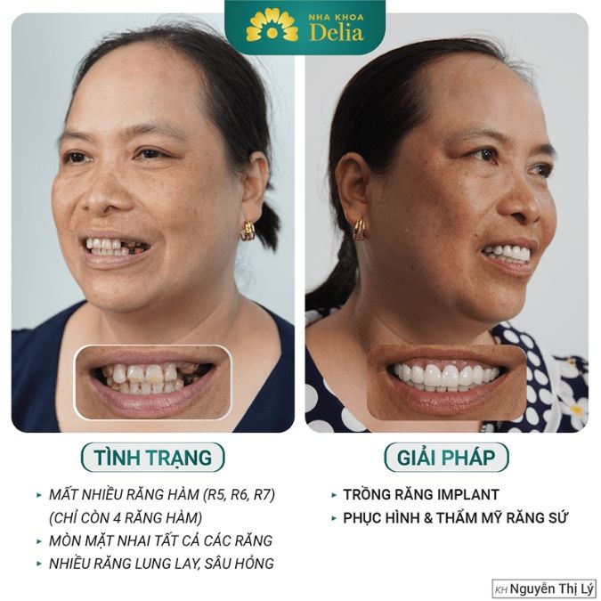 Trồng răng Implant 4s
