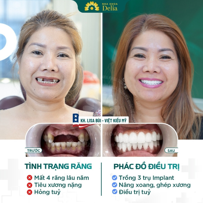 Cấy trồng Implant mất bao lâu?