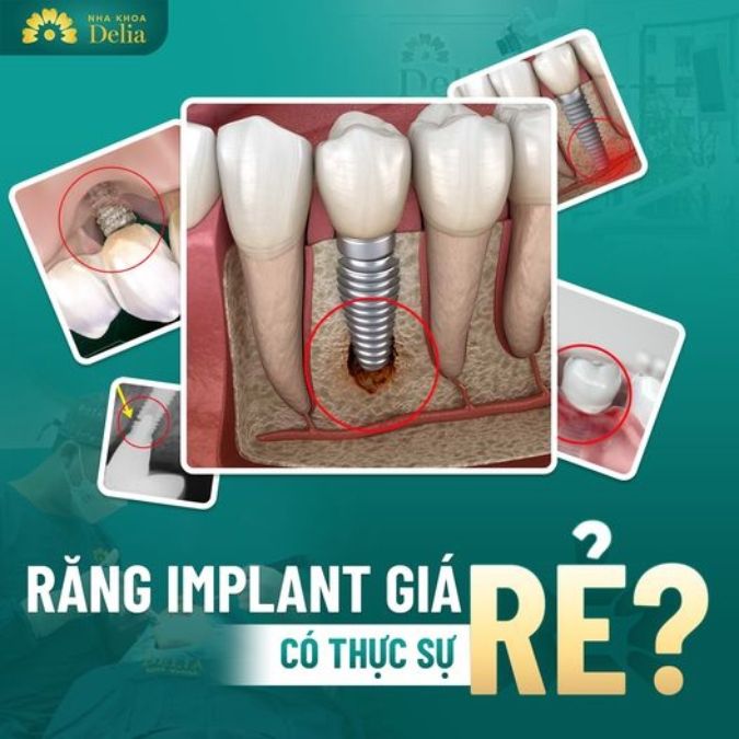 Quá trình trồng răng Implant không đúng kỹ thuật để lại những hậu quả gì?