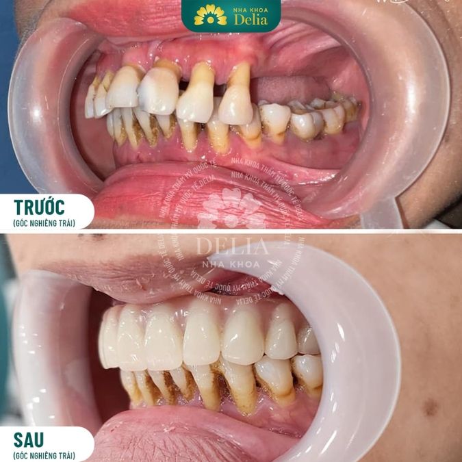 Cận cảnh quy trình trồng răng Implant vĩnh viễn cho người già tại Nha khoa Delia