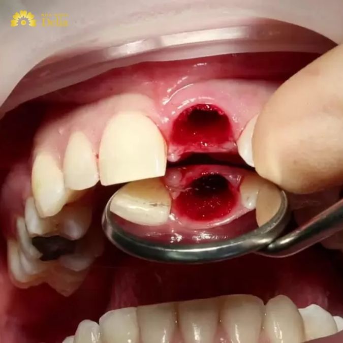Biến chứng trồng răng Implant