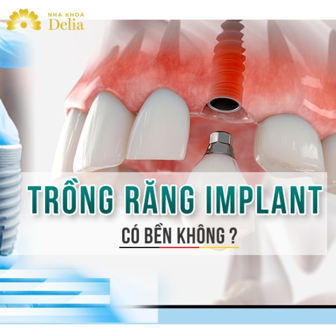 Thời gian Implant tồn tại trên xương hàm của người bệnh là từ 30 – 40 năm