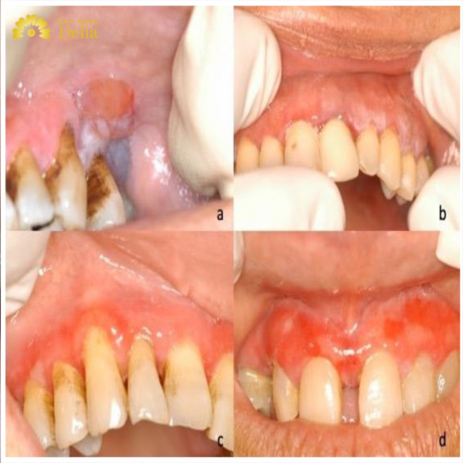 Biểu hiện của viêm nướu cấp tính: xuất hiện vết loét, sưng đỏ