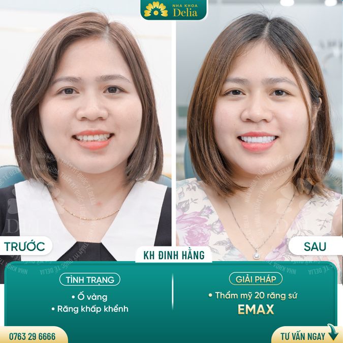 99+ Dáng răng sứ "độc bản" tại nha khoa Delia