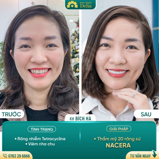 99+ Dáng răng sứ "độc bản" tại nha khoa Delia