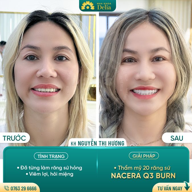 99+ Dáng răng sứ "độc bản" tại nha khoa Delia