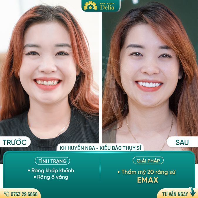 99+ Dáng răng sứ "độc bản" tại nha khoa Delia
