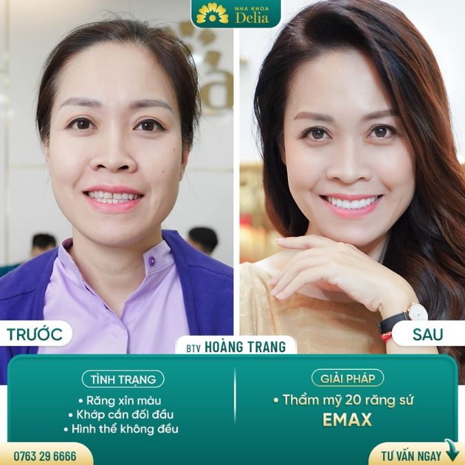 99+ Dáng răng sứ "độc bản" tại nha khoa Delia