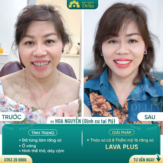 99+ Dáng răng sứ "độc bản" tại nha khoa Delia