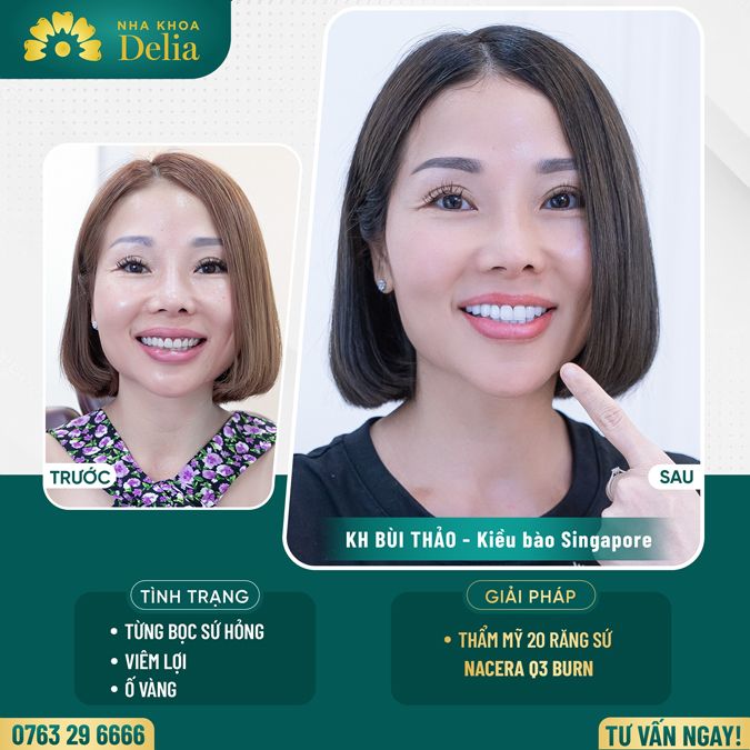 99+ Dáng răng sứ "độc bản" tại nha khoa Delia