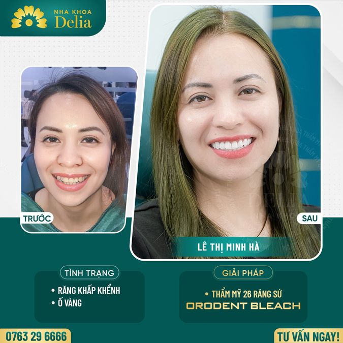 99+ Dáng răng sứ "độc bản" tại nha khoa Delia