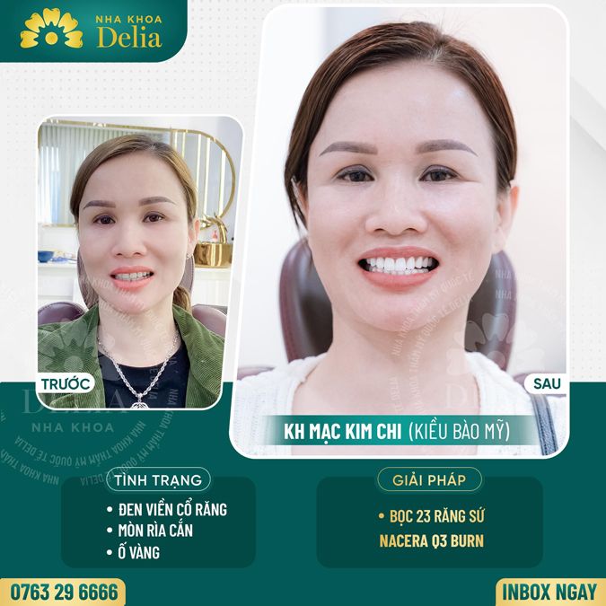 99+ Dáng răng sứ "độc bản" tại nha khoa Delia