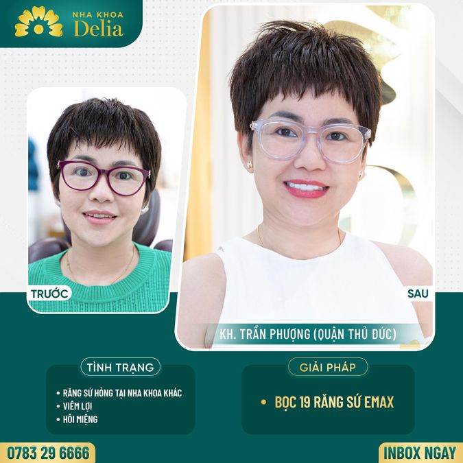 99+ Dáng răng sứ "độc bản" tại nha khoa Delia