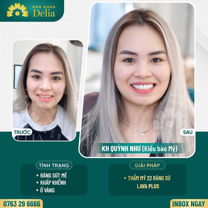99+ Dáng răng sứ "độc bản" tại nha khoa Delia
