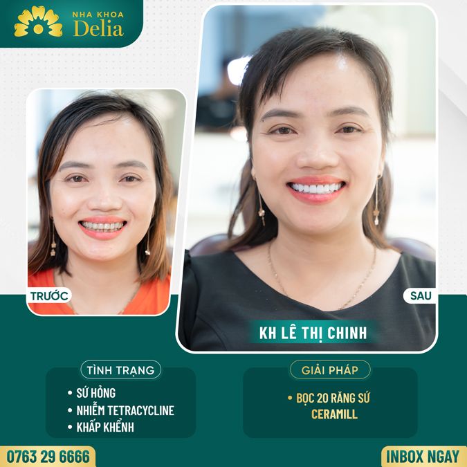 99+ Dáng răng sứ "độc bản" tại nha khoa Delia