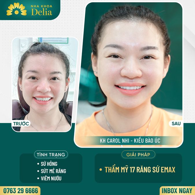 99+ Dáng răng sứ "độc bản" tại nha khoa Delia