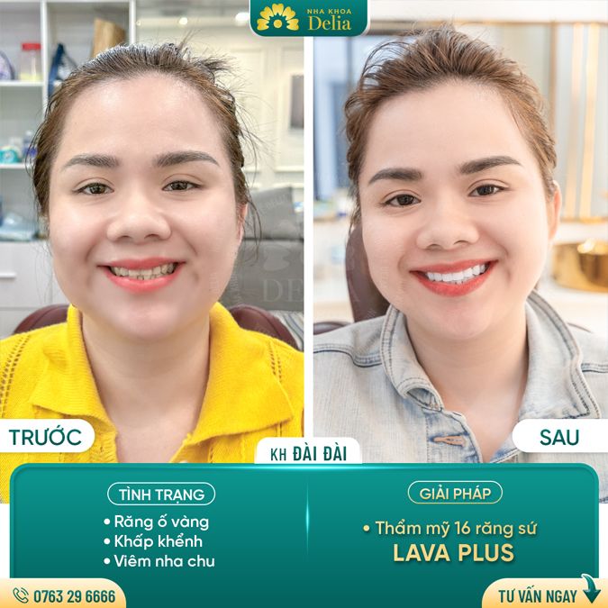 99+ Dáng răng sứ "độc bản" tại nha khoa Delia