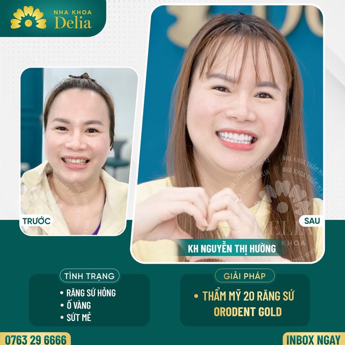 99+ Dáng răng sứ "độc bản" tại nha khoa Delia