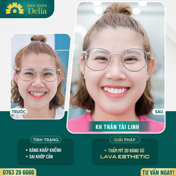 99+ Dáng răng sứ "độc bản" tại nha khoa Delia