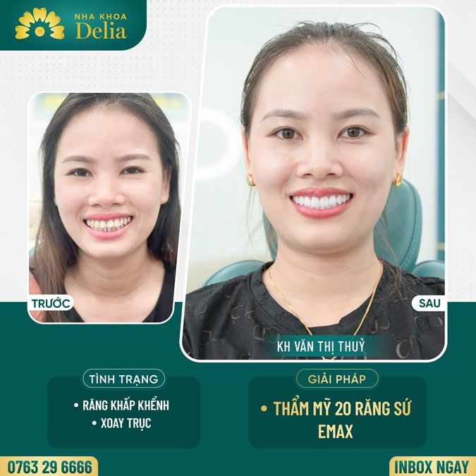 99+ Dáng răng sứ "độc bản" tại nha khoa Delia